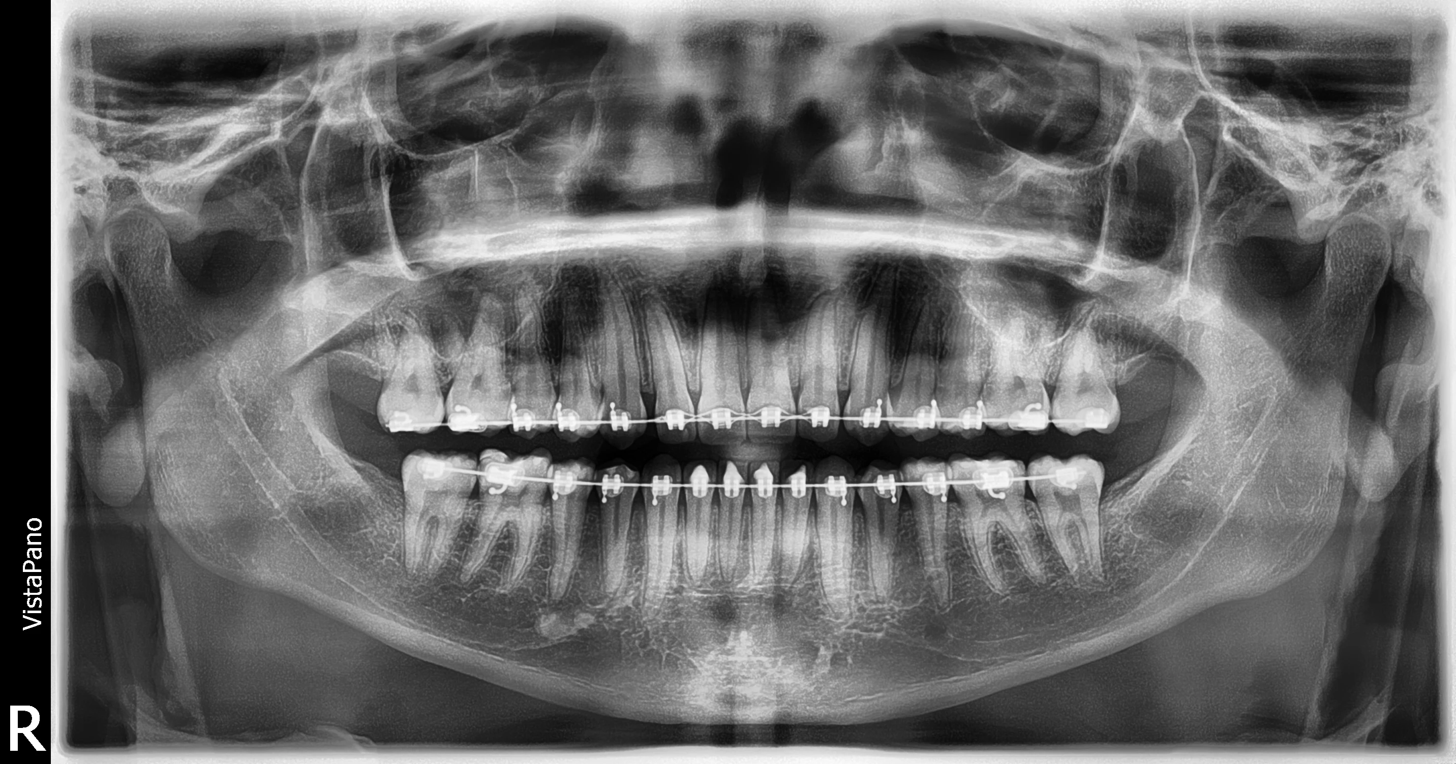 Radiografía panorámica de tratamiento integral con ortodoncia
